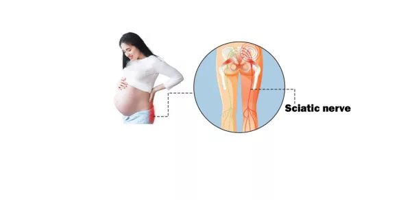 Sciatica Pain Guide